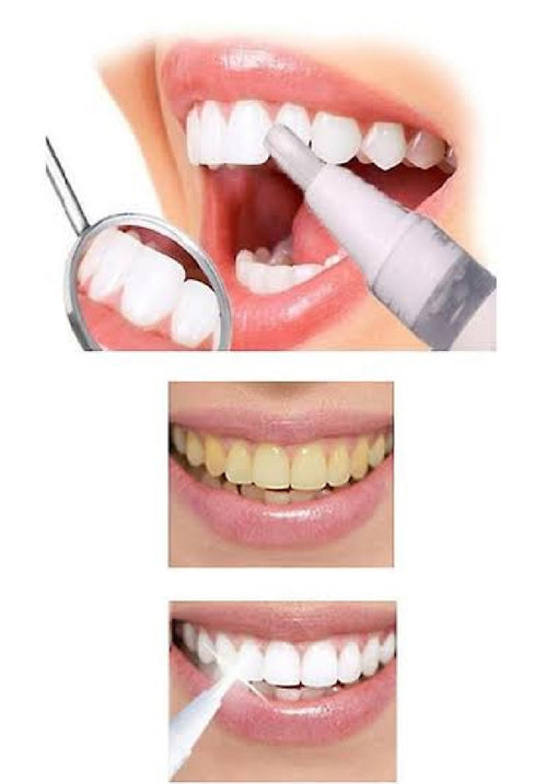 Natural Teeth Whitening Pen – Instant Whitening Gel for Bright Smile