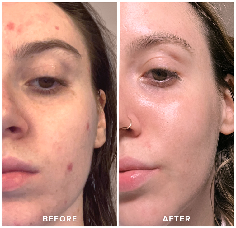 Silicon Ice Face Roller – Reusable Facial Massager to Reduce Puffiness